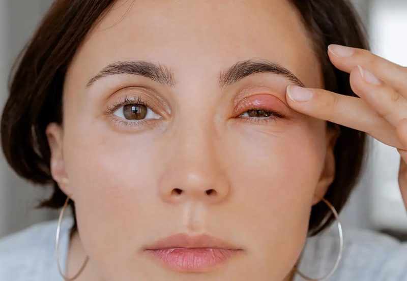 درمان بیماری های چشم با طب قرآنی و عسل درمانی