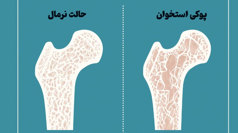 بیماری پوکی استخوان